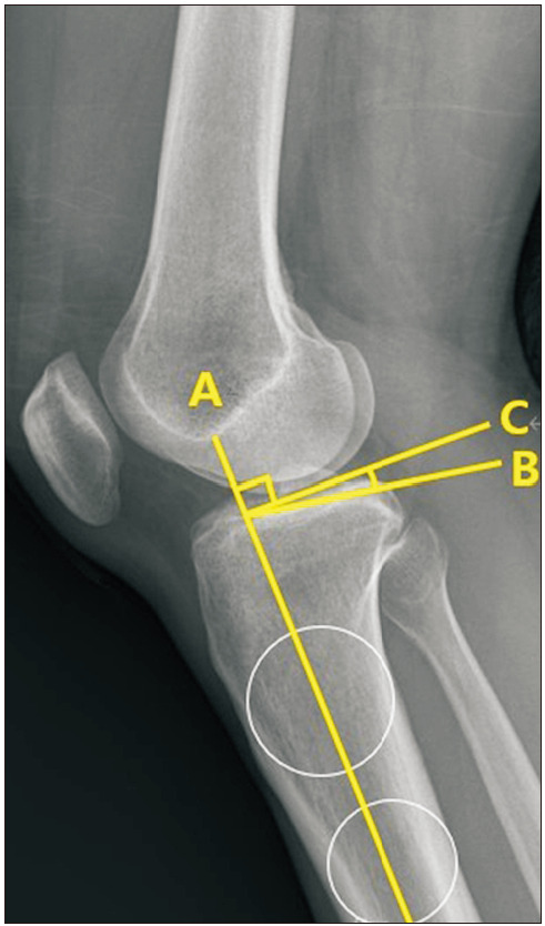 Do the Clinical and Radiological Features of Knees with Mucoid Degeneration of the Anterior Cruciate Ligament Differ According to Knee Osteoarthritis Status?