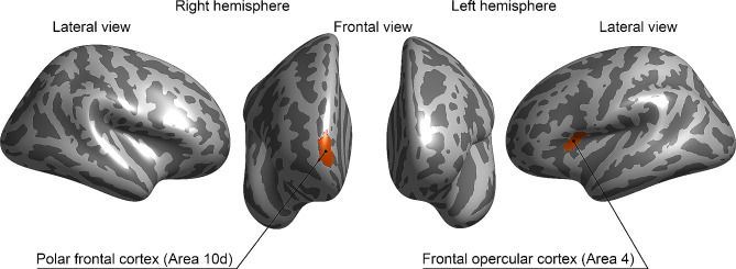 Alterations in neural activation in the ventral frontoparietal network during complex magnocellular stimuli in developmental dyslexia associated with READ1 deletion.