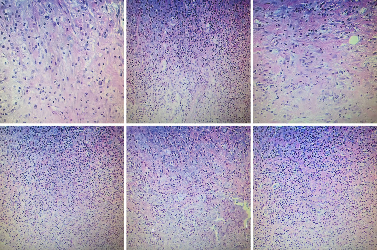 A sarcomatoid malignancy originating in the right cervical lymph nodes with atypical pathological characteristics: a case report of an incidental finding.