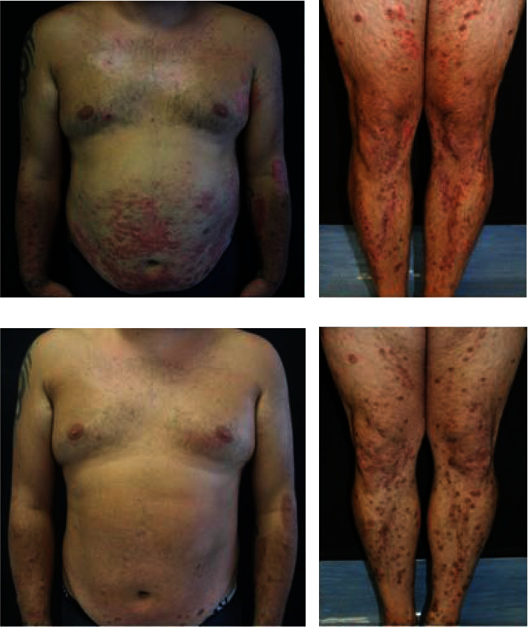 Successful Use of Dupilumab in the Treatment of Acquired Perforating Dermatosis Associated with Atopic Dermatitis.