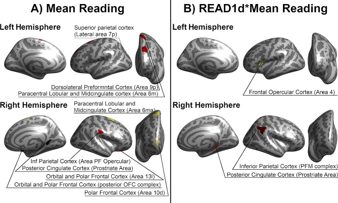 Alterations in neural activation in the ventral frontoparietal network during complex magnocellular stimuli in developmental dyslexia associated with READ1 deletion.