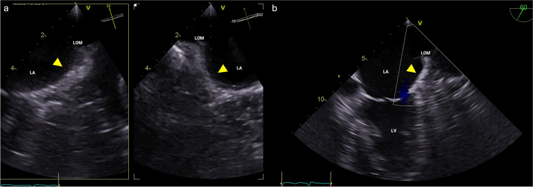 Confirmation of absence: the need for advanced imaging of the left atrial appendage.