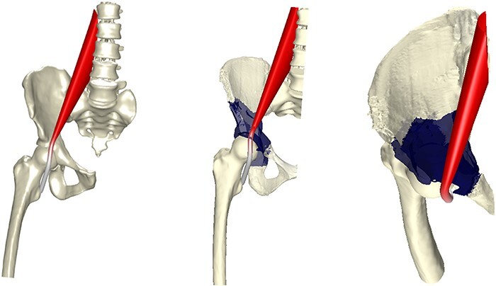 Understanding recurrent groin pain following periacetabular osteotomy: assessment of psoas tendon mechanics using discrete element analysis.