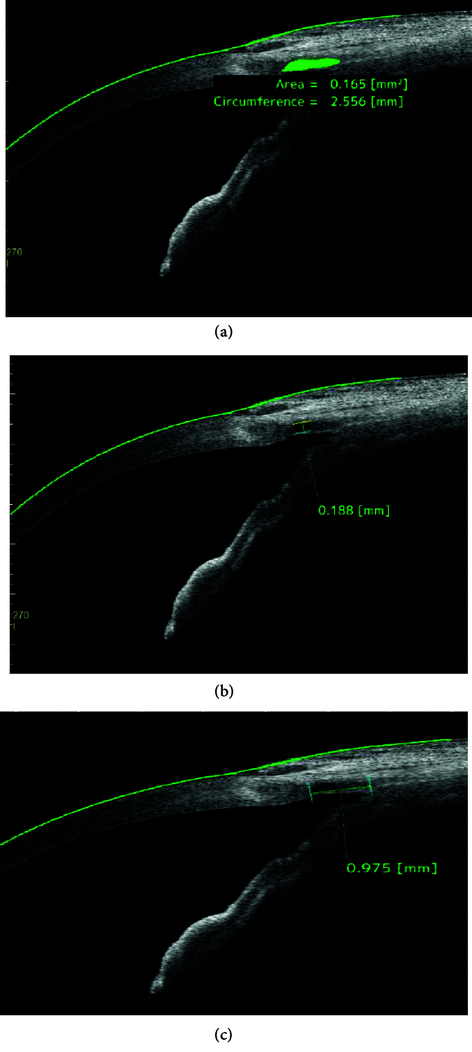 Evaluation of Intrascleral Lakes after Phaco-Viscocanalostomy using Anterior Segment Optical Coherence Tomography.