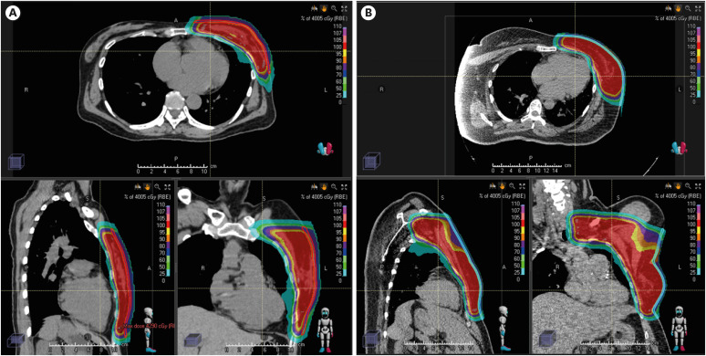 Dosimetric Correlation of Acute Radiation Dermatitis in Patients With Breast Cancer Undergoing Hypofractionated Proton Beam Therapy Using Pencil Beam Scanning.