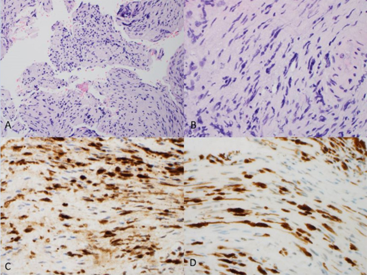 Clinical and Genomic Profile of Primary Cranial Neurolymphomatosis.