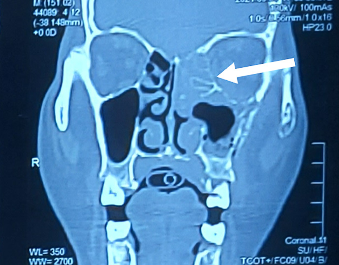 A Rare Case of Coronavirus Disease 2019 Encephalitis Mimicking Creutzfeldt-Jacob Disease in an Immunocompromised Patient: A Case Report.