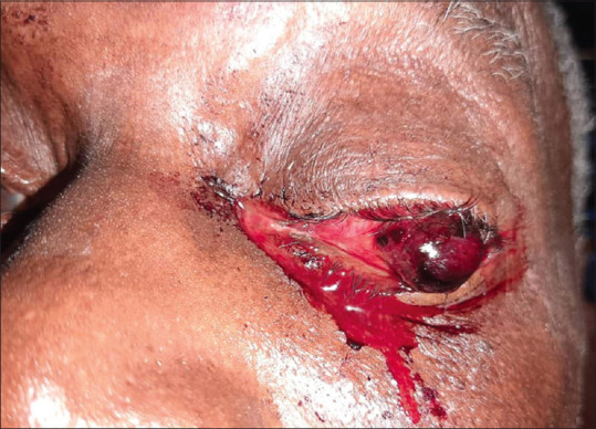 Spontaneous Globe Rupture following Prolonged Uncontrolled Elevated Intraocular Pressure.