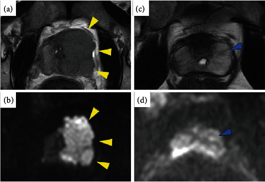 Robot-Assisted Laparoscopic Radical Prostatectomy for Prostatic Metastatic Recurrence from Testicular Cancer.