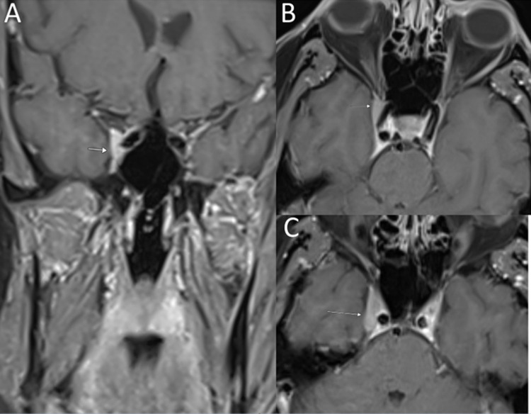 Clinical and Genomic Profile of Primary Cranial Neurolymphomatosis.