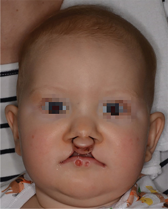 Surgical Treatment of Lip Pits in Van der Woude Syndrome: A Preliminary Retrospective Study of 24 Patients.
