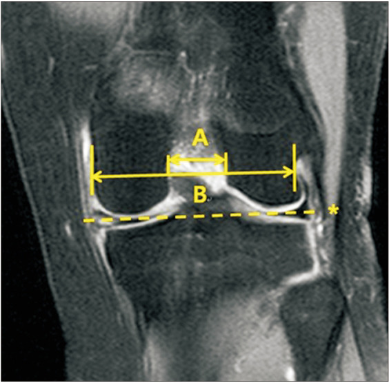 Do the Clinical and Radiological Features of Knees with Mucoid Degeneration of the Anterior Cruciate Ligament Differ According to Knee Osteoarthritis Status?