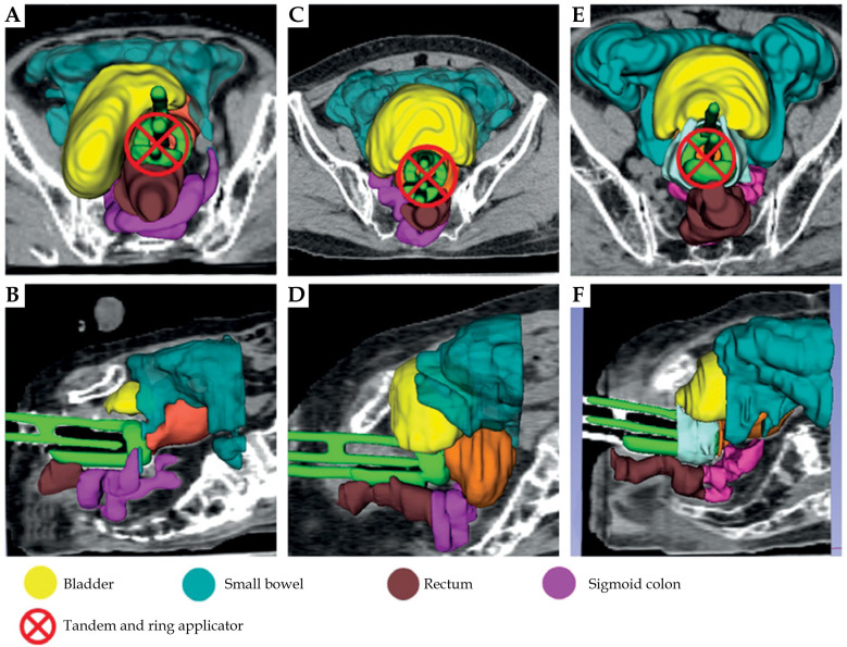 MRI-guided brachytherapy for cervical cancer treatment: The significance of bladder morphology in dose distribution planning.