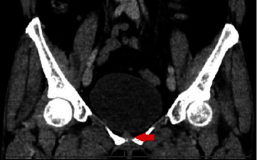 Chondroma in the Urinary Bladder: An Extremely Rare Finding.