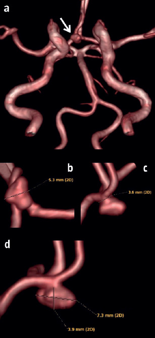 Hemorrhagic adenoma mimicking anterior communicating artery aneurysm.