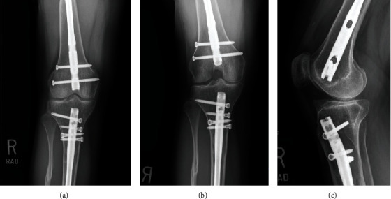 Excision of Intra-articular Knee Heterotopic Ossification Using a 70° Arthroscope.