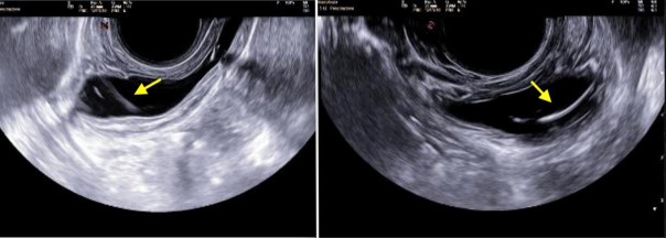 Intravesical misplacement of vaginal contraceptive ring: a video report and review of the literature.