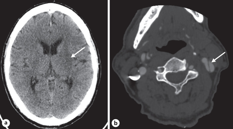 Endovascular Mechanical Thrombectomy for Ischemic Stroke Treatment in the Setting of Aortic Dissection: Case Report.