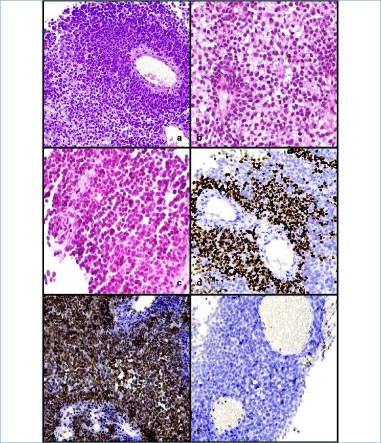 SMARCB1/INI1-deficient undifferentiated tumour of the thorax: a case report and review of the literature.