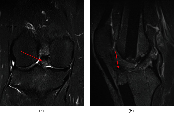 Excision of Intra-articular Knee Heterotopic Ossification Using a 70° Arthroscope.