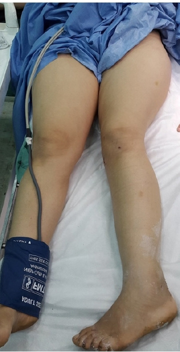 Relevance of the Watson-Jones anterolateral approach in the management of Pipkin type II fracture-dislocation: a case report and literature review.