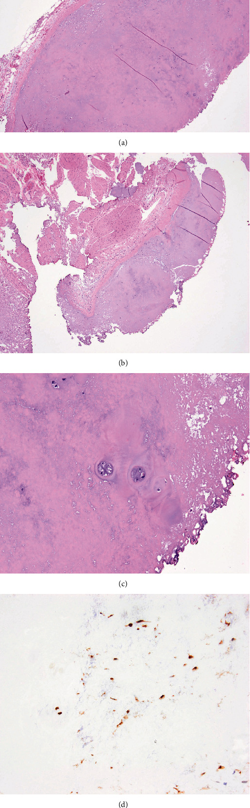 Chondroma in the Urinary Bladder: An Extremely Rare Finding.