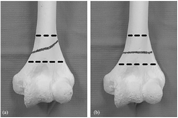 Management of pediatric distal humerus metaphyseal-diaphyseal junction fracture: A systematic review and meta-analysis.