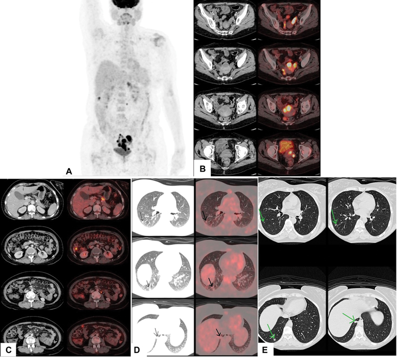 Beyond the Marrow: Unveiling Uncommon Sites of ALL Relapse with <sup>18</sup> F-FDG PET/CT.