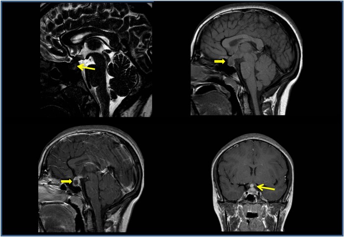 Diabetes Insipidus Complicating Diabetes Mellitus Type 1: A Pituitary Abscess Diagnosis.