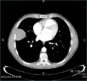 SMARCB1/INI1-deficient undifferentiated tumour of the thorax: a case report and review of the literature.