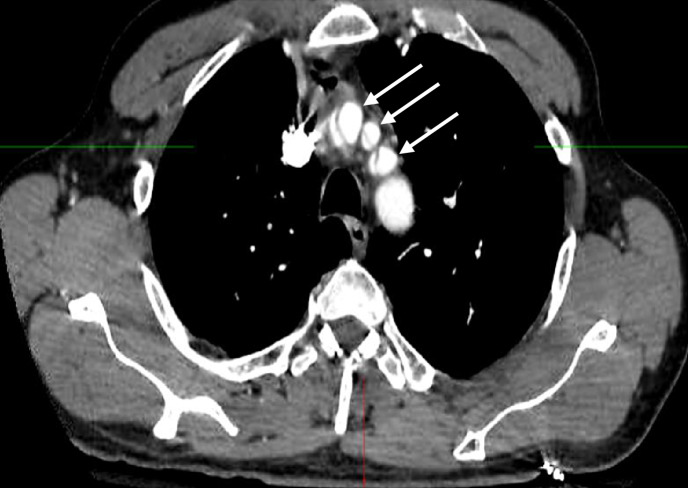 Endovascular Mechanical Thrombectomy for Ischemic Stroke Treatment in the Setting of Aortic Dissection: Case Report.