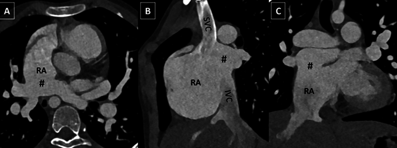 Total Anomalous Pulmonary Venous Connection with Rare Direct Right Atrial Drainage and Unprecedented Array of Coexistent Multisystem Variations.