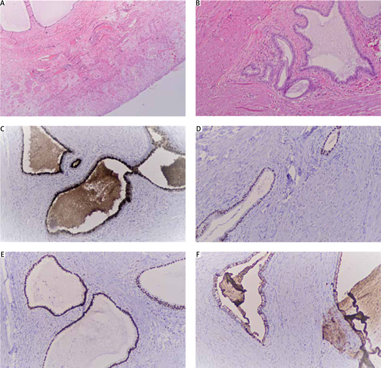 Clinical aspects and therapeutic strategy in a case of urinary bladder endocervicosis.