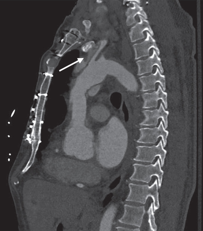 Endovascular Mechanical Thrombectomy for Ischemic Stroke Treatment in the Setting of Aortic Dissection: Case Report.
