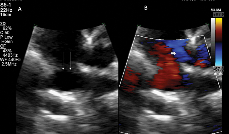 Total Anomalous Pulmonary Venous Connection with Rare Direct Right Atrial Drainage and Unprecedented Array of Coexistent Multisystem Variations.