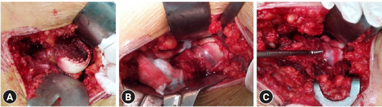 Relevance of the Watson-Jones anterolateral approach in the management of Pipkin type II fracture-dislocation: a case report and literature review.