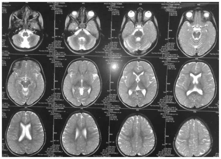 Cerebral Folate Transport Deficiency in 2 Cases with Intractable Myoclonic Epilepsy.