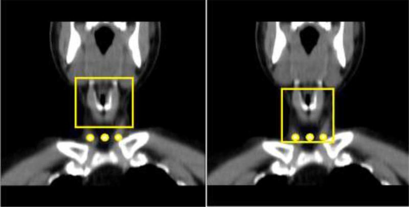 Assessment of the Absorbed Dose Variations in the Thyroid Gland Exposed to Orthopantomography (OPG) while Swallowing: A Novel Approach to Radiation Protection.