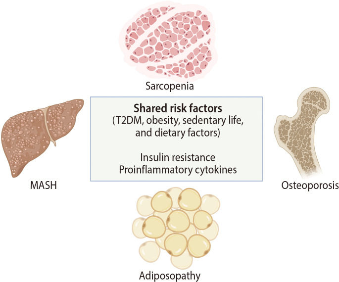 Effects of Metabolic Dysfunction-Associated Steatotic Liver Disease on Bone Density and Fragility Fractures: Associations and Mechanisms.