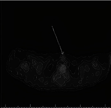 Parathyroid Paranoia: Unveiling Psychosis in Hyperparathyroidism.