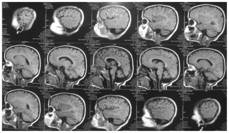 Cerebral Folate Transport Deficiency in 2 Cases with Intractable Myoclonic Epilepsy.