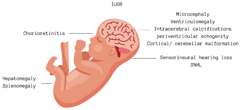 Congenital Cytomegalovirus-Related Hearing Loss.