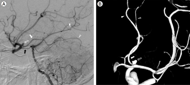 Coil embolization and recurrence of ruptured aneurysm originating from hyperplastic anterior choroidal artery.