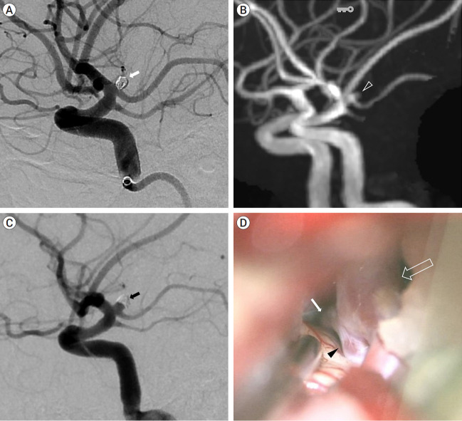 Coil embolization and recurrence of ruptured aneurysm originating from hyperplastic anterior choroidal artery.