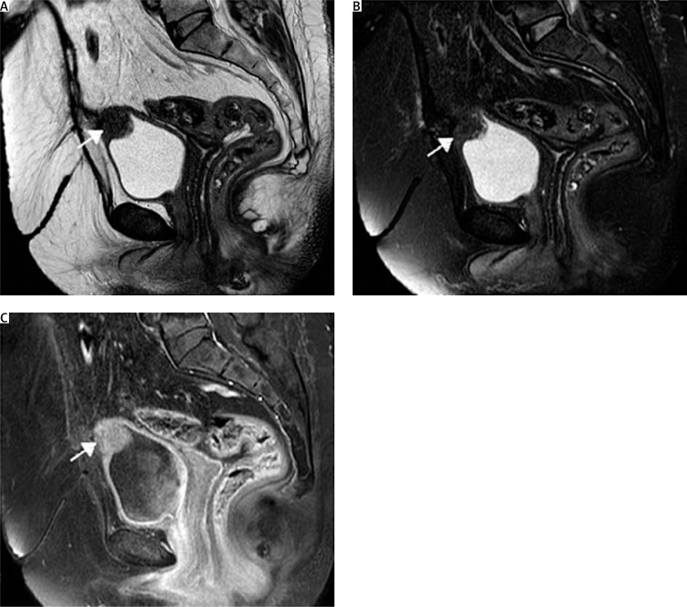 Clinical aspects and therapeutic strategy in a case of urinary bladder endocervicosis.
