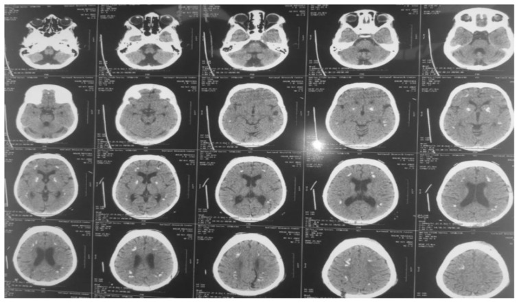 Cerebral Folate Transport Deficiency in 2 Cases with Intractable Myoclonic Epilepsy.