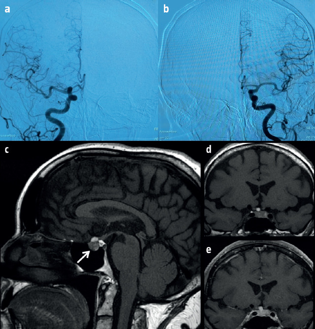 Hemorrhagic adenoma mimicking anterior communicating artery aneurysm.