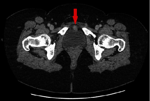 Chondroma in the Urinary Bladder: An Extremely Rare Finding.