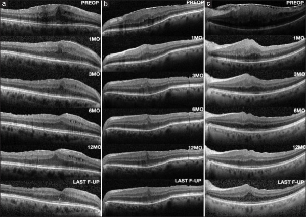 Long-term Follow-up Results of Idiopathic Epiretinal Membrane Removal in the Eyes with Ectopic Inner Foveal Retinal Layers.