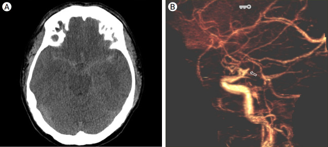 Coil embolization and recurrence of ruptured aneurysm originating from hyperplastic anterior choroidal artery.